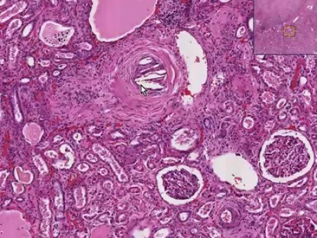 Zator cholesterolowy - histopatologia nerek