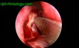 Udrożnianie dróg łzowych (dakrocystorhinostomia) w endoskopii