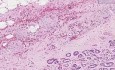 Prostata - Gruczolakorak (Gleason klasa 3) - Badanie histopatologiczne