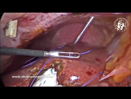 Techniki laparoskopowego zamykania portu