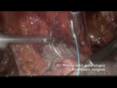 Laparoskopowy zabieg pektopeksji przy wypadaniu układu moczowo-płciowego u otyłej pacjetki