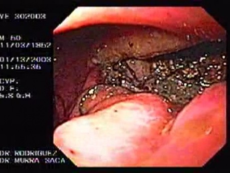 Cystogastrostomia (5 z 5)