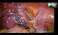 Szybka i bezpieczna histerektomia laparoskopowa