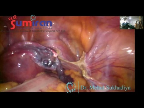 Szybka i bezpieczna histerektomia laparoskopowa