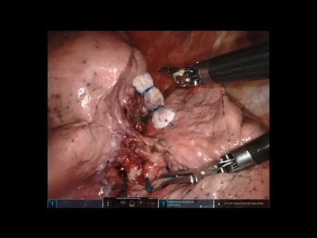 Nieedytowana robotyczna lobektomia lewego płata górnego w leczeniu synchronicznych pierwotnych obustronnych guzów płuc