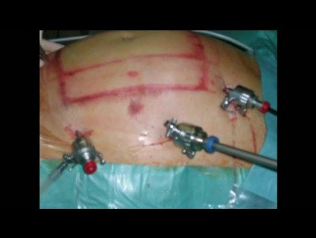 Jednoczasowa laparoskopowa plastyka przepukliny pępkowa i przepukliny Spiegla z wszczepieniem siatki