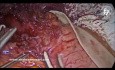 Laparoskopowa miotomia Hellera i fundoplikacja metodą Dora
