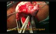 Operacja Manchesterska (usunięcie szyjki macicy z plastyką przednią)
