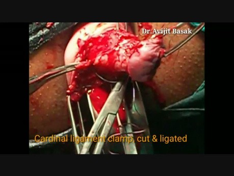 Operacja Manchesterska (usunięcie szyjki macicy z plastyką przednią)