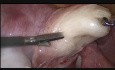 Miomektomia laparoskopowa mięśniaka tylnej ściany macicy