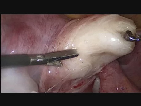 Miomektomia laparoskopowa mięśniaka tylnej ściany macicy