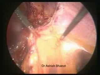 Operacja laparoskopowa przepuklin w bliźnie pooperacyjnej