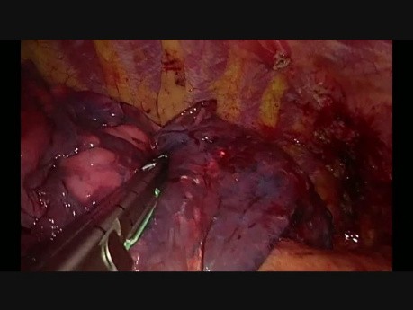 Wideotorakoskopowa prawa dolna lobektomia z jednego cięcia podmostkowego z powodu dużego guza