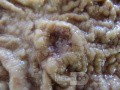 Gruczolakorak okolicy przedoddźwiernikowej i wcięcia kątowego żołądka (7 z 12)