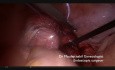 Miomektomia laparoskopowa- jak wyjść poza wskazania