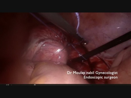 Miomektomia laparoskopowa- jak wyjść poza wskazania