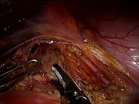 Uszkodzenie pnia trzewnego podczas operacji laparoskopowej zespołu więzadła łukowatego pośrodkowego (MALS, zespół Dunbara)
