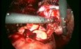 Endometrioza - operacja laparoskopowa