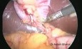 Cholecystektomia laparoskopowa metodą trzech małych cięć