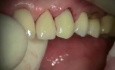 Natychmiastowa implantacja zęba 23 z komplikacjami