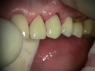 Natychmiastowa implantacja zęba 23 z komplikacjami