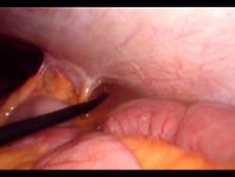 Perforacja okrężnicy z zapaleniem otrzewnej - laparoskopia (35 z 46)