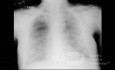 RTG klatki piersiowej - COVID-19 (4)