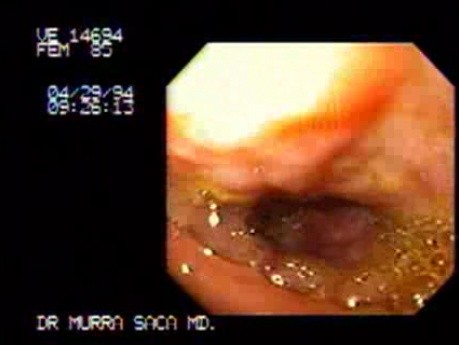 Rozlana metaplazja jelitowa - endoskopia