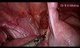 Appendektomia laparoskopowa