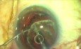 Ablacja plazmowa - kapsulotomia: nóż Fugo konta laser femtosekundowy