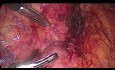 Resekcja laparoskopowa nerwiaka przyzwojowego (paraganglioma) okolicy zaotrzewnowej