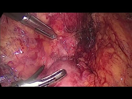 Resekcja laparoskopowa nerwiaka przyzwojowego (paraganglioma) okolicy zaotrzewnowej