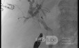 Endoskopowa choledochoduodenostomia pod kontrolą EUS [3/7]