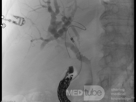 Endoskopowa choledochoduodenostomia pod kontrolą EUS [3/7]