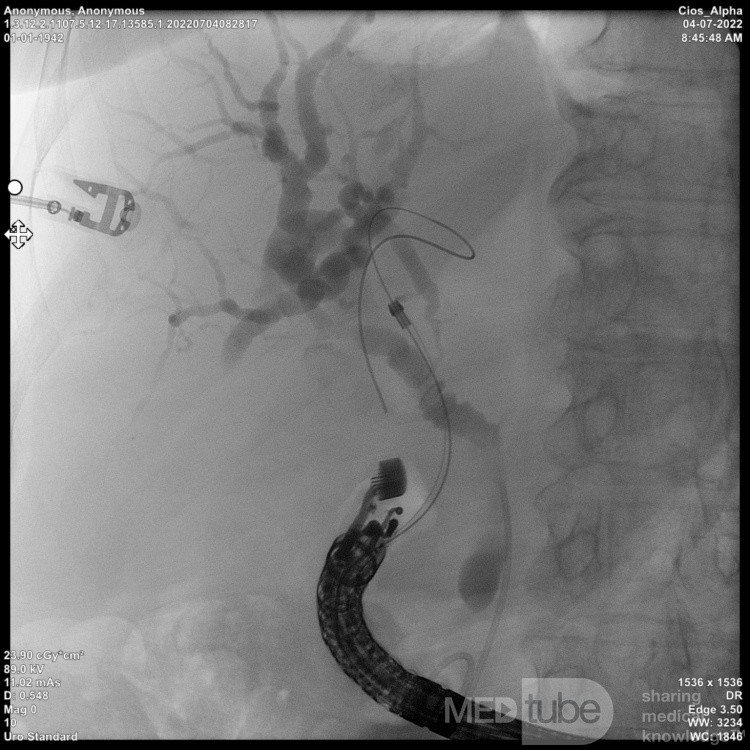 Endoskopowa choledochoduodenostomia pod kontrolą EUS [3/7]