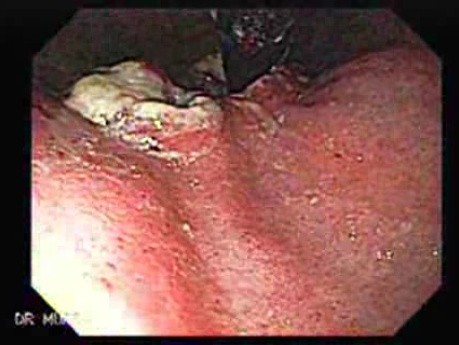 Rak płaskonabłonkowy przełyku - wrzodziejąca rana dna żołądka widziana w inwersji endoskopowej