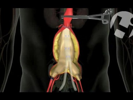 Nieprawidłowe leczenie chirurgiczne tętniaka aorty
