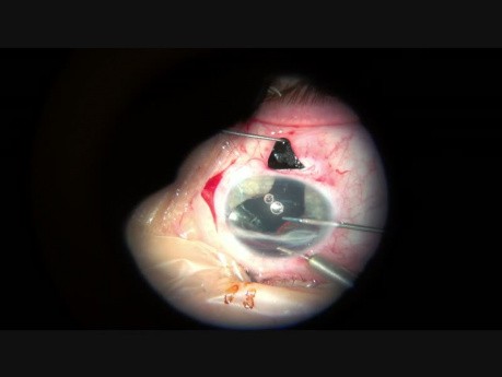 Operacja  wymiany sztucznej soczewki i jednoczasowego wszczepienia częściowego implantu tęczówki