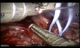 Gruczolakorak płuca z zajęciem szczeliny międzypłatowej