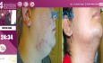 Metformina, propranolol, kwas traneksamowy w dermatologii