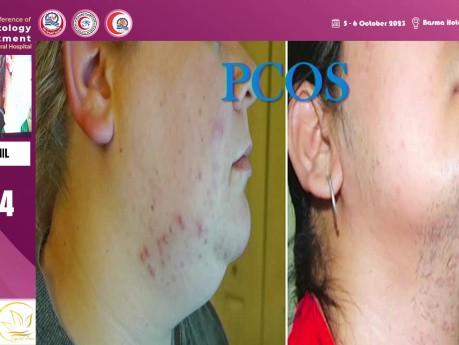 Metformina, propranolol, kwas traneksamowy w dermatologii