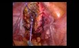 Postępowanie laparoskopowe u pacjentki z gruczolakomięśniakiem leczącej się z powodu bezpłodności