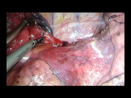 Wideotorakoskopia - operacja z użyciem jedynie noża harmonicznego i magnetycznego graspera