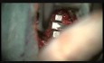 Mikrodiscektomia szyjna z artroplastyką przy użyciu ruchomej protezy dysku