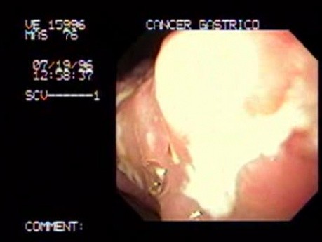Gruczolakorak żołądka z licznymi wrzodami - endoskopia