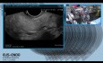 Termoablacja (RFA) pod kontrolą ultrasonografii endoskopowej (EUS) z użyciem środka kontrastowego (SonoVue)