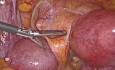 Całkowita laparoskopowa histerektomia z powodu macicy dwurożnej