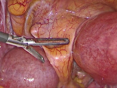 Całkowita laparoskopowa histerektomia z powodu macicy dwurożnej
