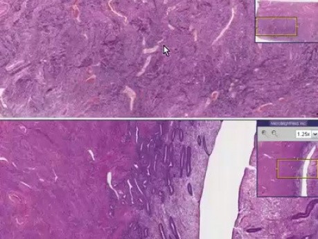 Starczy uwiąd - Badanie histopatologiczne - Endometrium