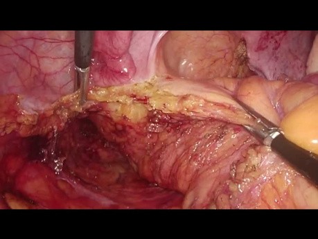 Laparoskopowa międzyzwieraczowa resekcja raka odbytnicy z zajęciem odbytu (intra-anal)